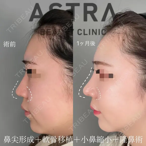 隆鼻術/鼻尖形成/軟骨移植/小鼻縮小 after画像 メイン用