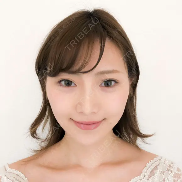 【ヒアルロン酸クレヴィエル】ジャスミンノーズ after画像 メイン用