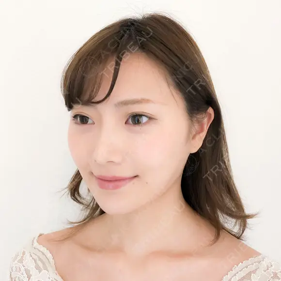 【ヒアルロン酸クレヴィエル】ジャスミンノーズ after画像 メイン用