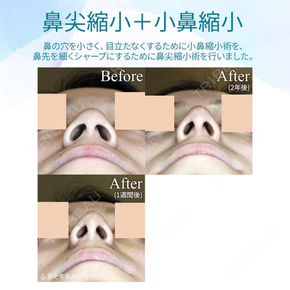 【20代女性・存在感のない「忘れ鼻」に】小鼻縮小術+α法 ＆ 鼻尖縮小術+α法（2年後） after画像 メイン用
