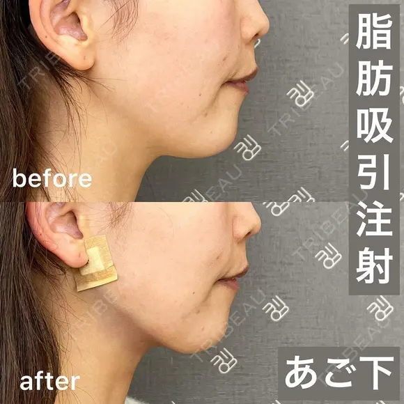 脂肪吸引注射｜あご下 after画像 メイン用