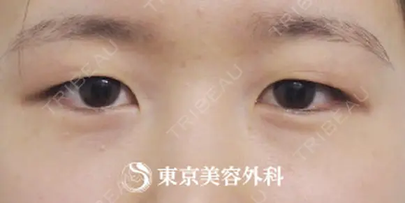 二重埋没 before画像 メイン用