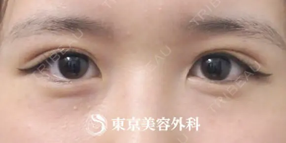 二重埋没 after画像 メイン用