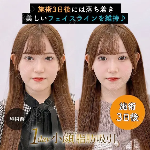 1day小顔®︎脂肪吸引（脂肪吸引（顔）＋糸リフト） before画像 メイン用