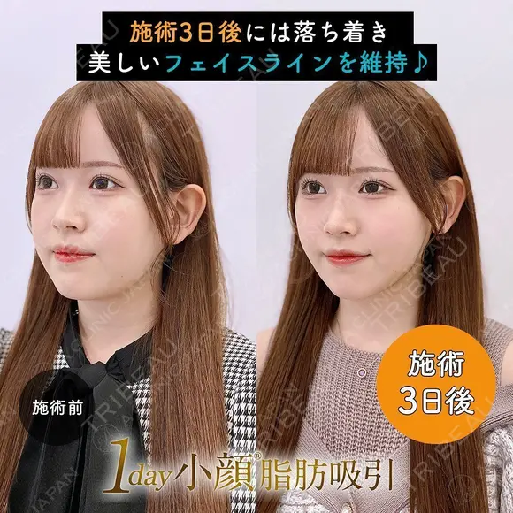 1day小顔®︎脂肪吸引（脂肪吸引（顔）＋糸リフト） 3日後 メイン用