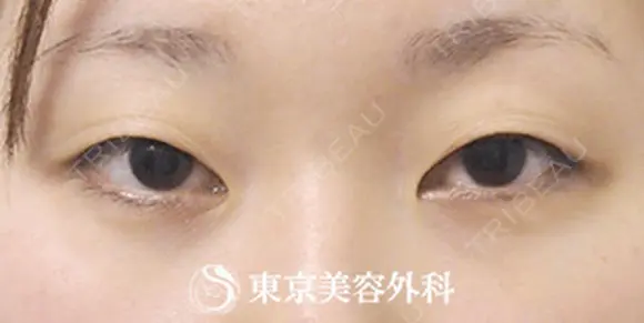 埋没二重(4点留め)、まぶたの脂肪取り before画像 メイン用