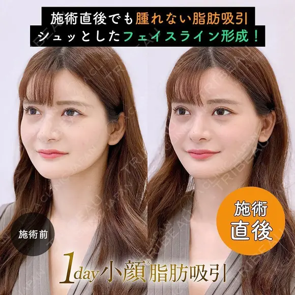 1day小顔®︎脂肪吸引（脂肪吸引（顔）＋糸リフト） after画像 メイン用