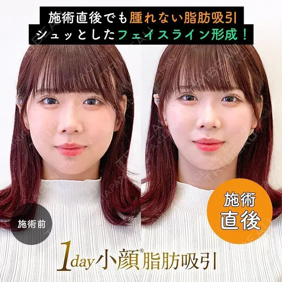 1day小顔®︎脂肪吸引（脂肪吸引（顔）＋糸リフト） 0日後 メイン用