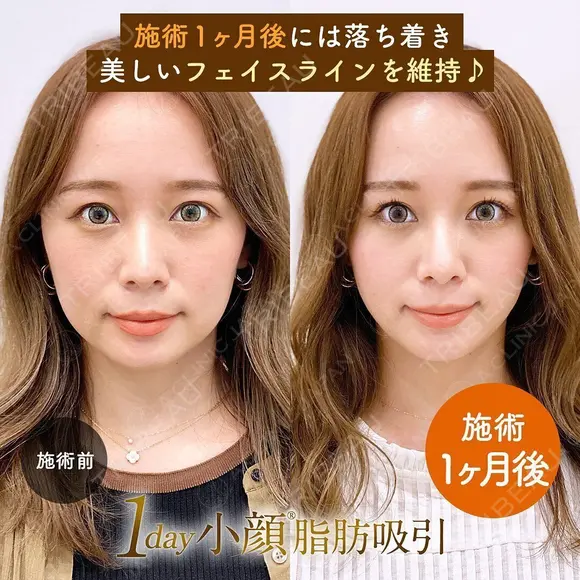 1day小顔®︎脂肪吸引（脂肪吸引（顔）＋糸リフト） before画像 メイン用