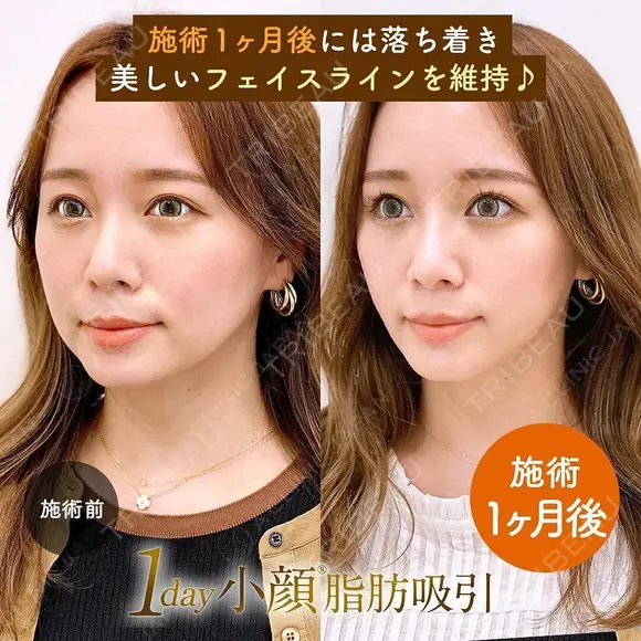 1day小顔®︎脂肪吸引（脂肪吸引（顔）＋糸リフト） 30日後 メイン用