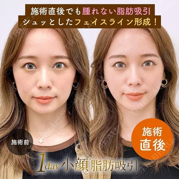 1day小顔®︎脂肪吸引（脂肪吸引（顔）＋糸リフト） after画像 メイン用