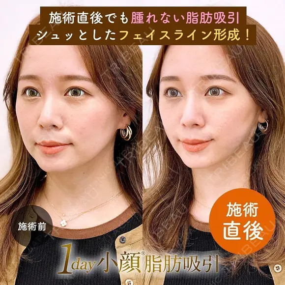 1day小顔®︎脂肪吸引（脂肪吸引（顔）＋糸リフト） after画像 メイン用
