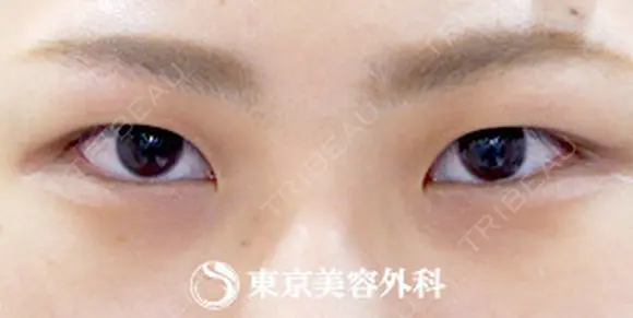 埋没二重(4点留め) before画像 メイン用