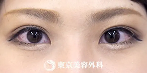 埋没二重(4点留め) after画像 メイン用