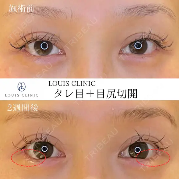 タレ目（埋没）+目尻切開 before画像 メイン用
