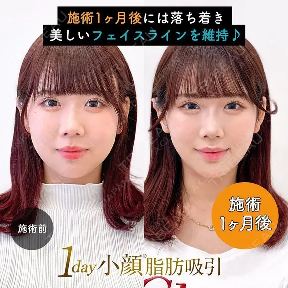 1day小顔®︎脂肪吸引（脂肪吸引（顔）＋糸リフト） before画像 メイン用