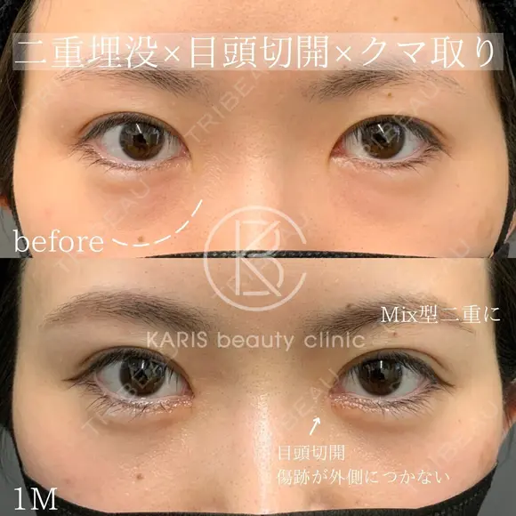 二重埋没埋没×韓流目頭切開×クマ取り before画像 メイン用