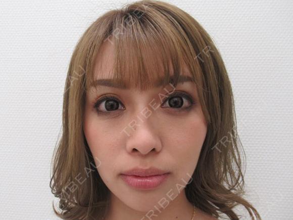 TAC式ツヤ肌コラーゲンリフト before画像 メイン用