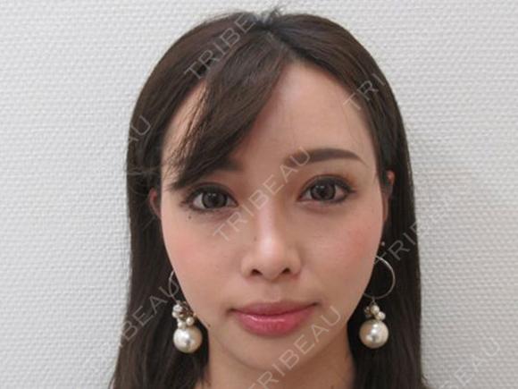 TAC式ツヤ肌コラーゲンリフト after画像 メイン用