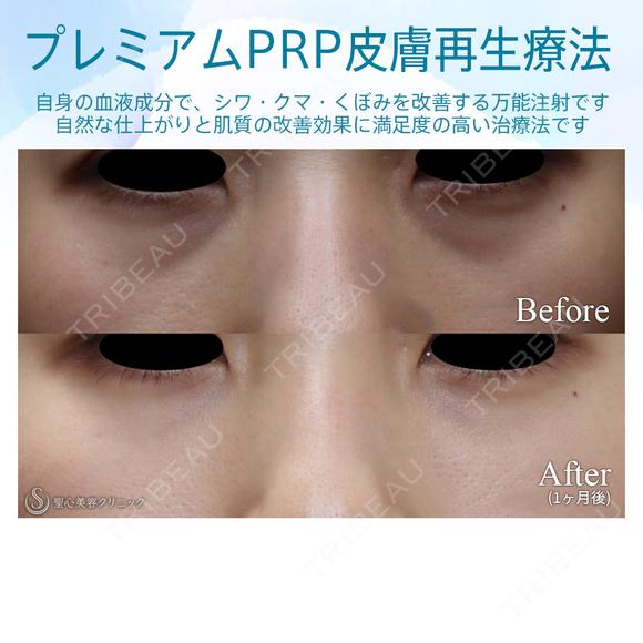 【20代女性・目の下のクマ、凹みを注入だけで改善】プレミアムPRP皮膚再生療法（1か月後） before画像 メイン用