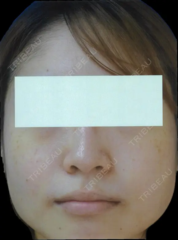 鼻翼縮小（外側） before画像 メイン用