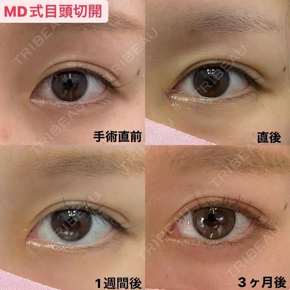 理想の目元になる😍目頭切開 90日後 メイン用