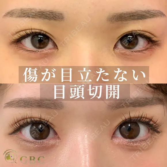 韓流目頭切開 before画像 メイン用