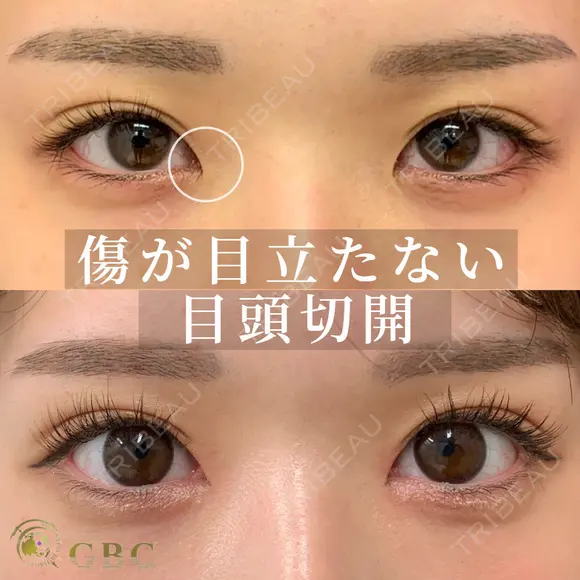 韓流目頭切開 after画像 メイン用