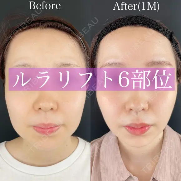 ルラリフト6部位 before画像 メイン用