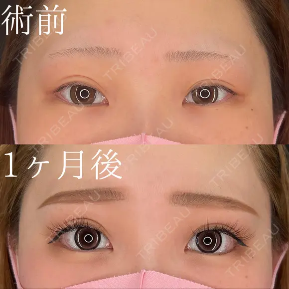 グラマラスライン切開 before画像 メイン用