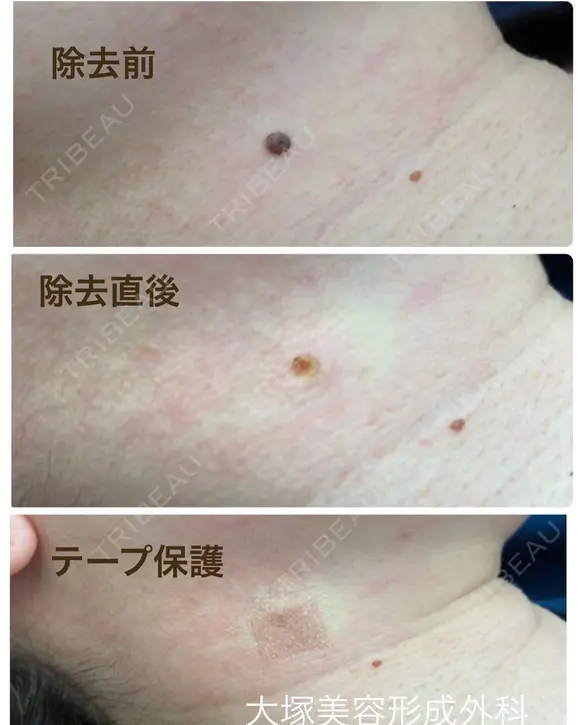 気になる"ほくろ"撃退👊ほくろ除去/CO2レーザー after画像 メイン用