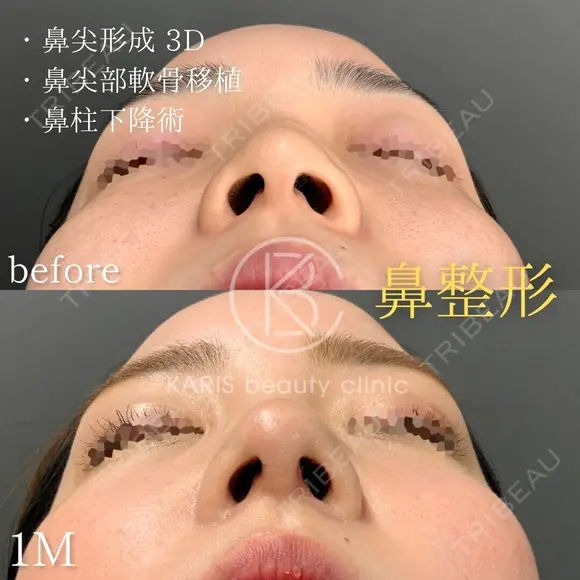 【鼻尖形成、鼻尖部軟骨移植、鼻柱下降術(closed)】 before画像 メイン用