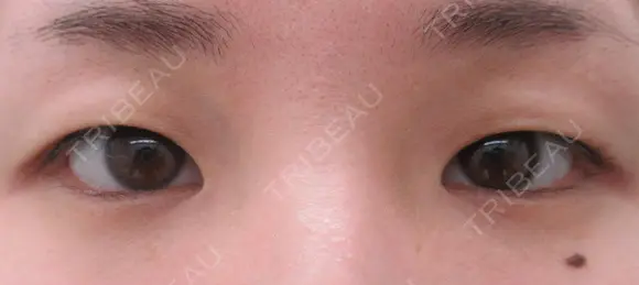全切開法二重術＋目頭切開 before画像 メイン用