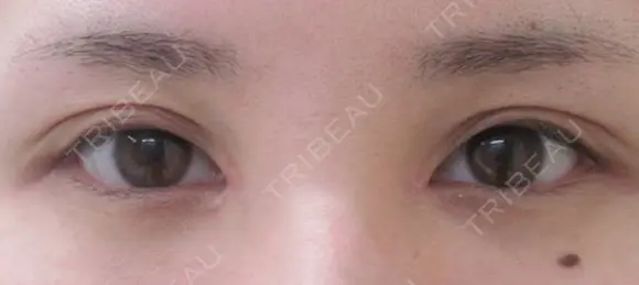 全切開法二重術＋目頭切開 after画像 メイン用