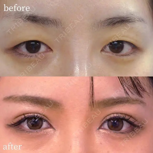 埋没二重４点留め before画像 メイン用