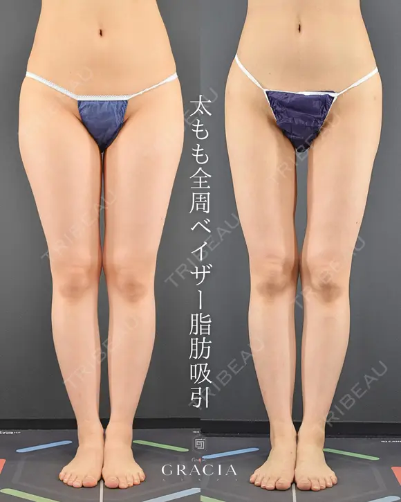 太腿全周ベイザー脂肪吸引 90日後 メイン用
