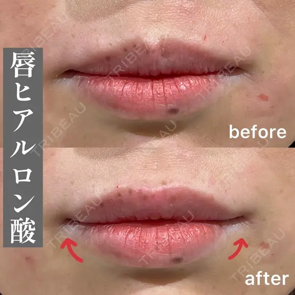 唇ヒアルロン酸　ボルベラ1cc before画像 メイン用