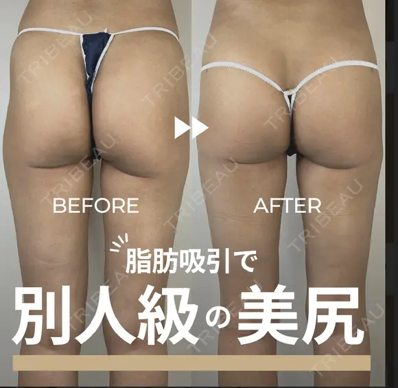 アキーセル　太もも脂肪吸引　フルコース before画像 メイン用