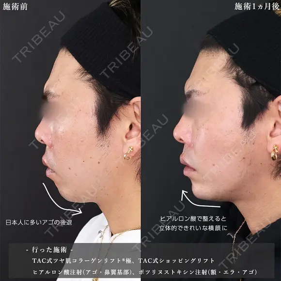 輪郭を整え、Sライン＆Eラインを作る😎 30日後 メイン用