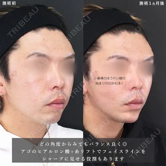 輪郭を整え、Sライン＆Eラインを作る😎 30日後 メイン用