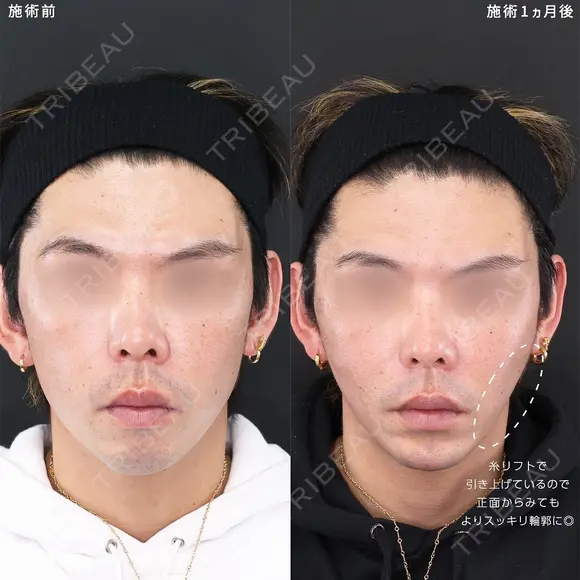 輪郭を整え、Sライン＆Eラインを作る😎 30日後 メイン用