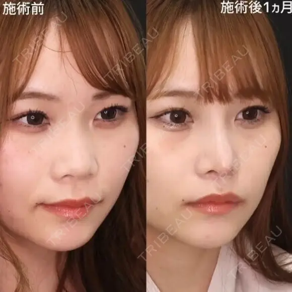 鼻先ツン🌷鼻筋の通った顔立ちに😌 30日後 メイン用