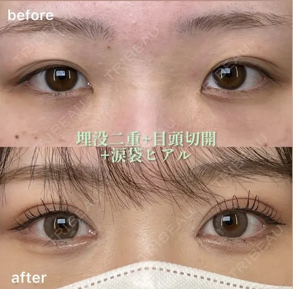 埋没二重術+目頭切開+涙袋ヒアルロン酸 after画像 メイン用