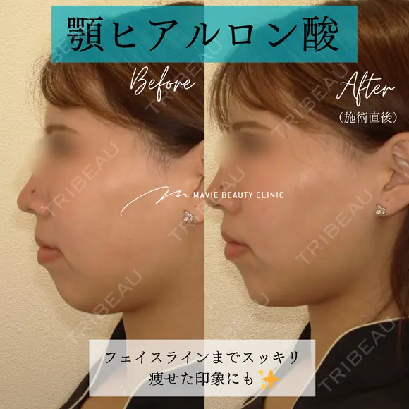 ヒアルロン酸注入（あご） 0日後 メイン用