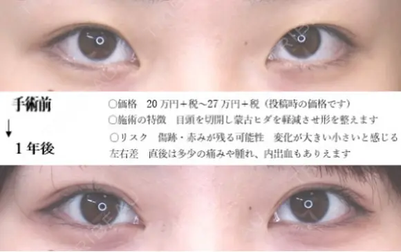 目頭切開法+埋没法 365日後 メイン用