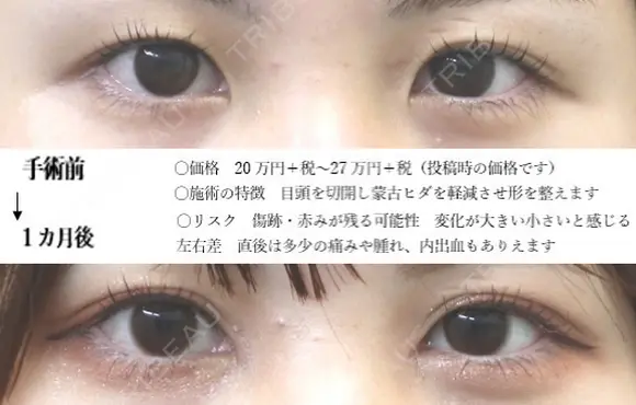 目頭切開+埋没法 30日後 メイン用