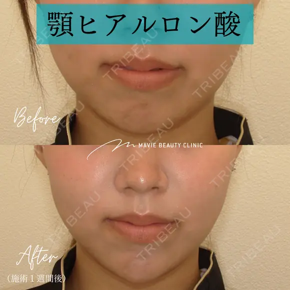 ヒアルロン酸注入（あご） 7日後 メイン用