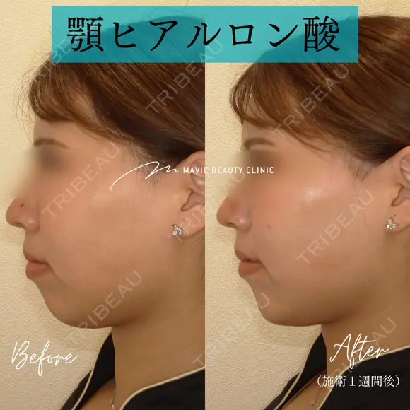 ヒアルロン酸注入（あご） 7日後 メイン用