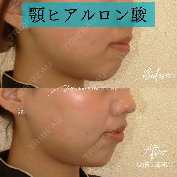 ヒアルロン酸注入（あご） 7日後 メイン用