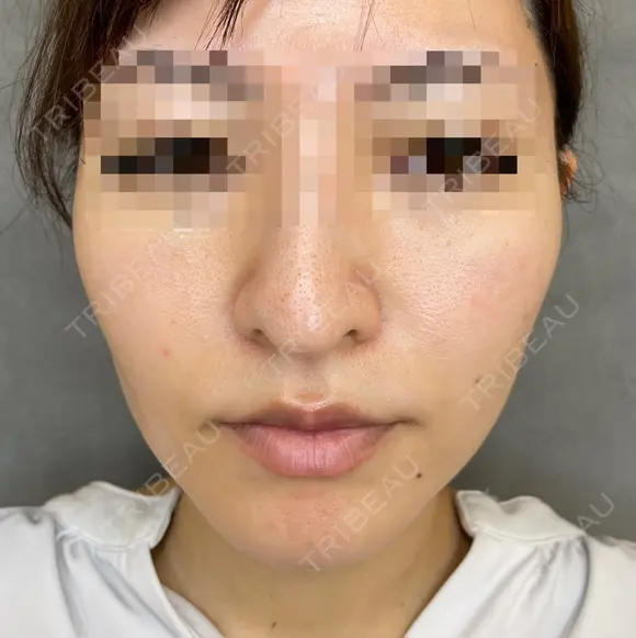 糸リフト before画像 メイン用